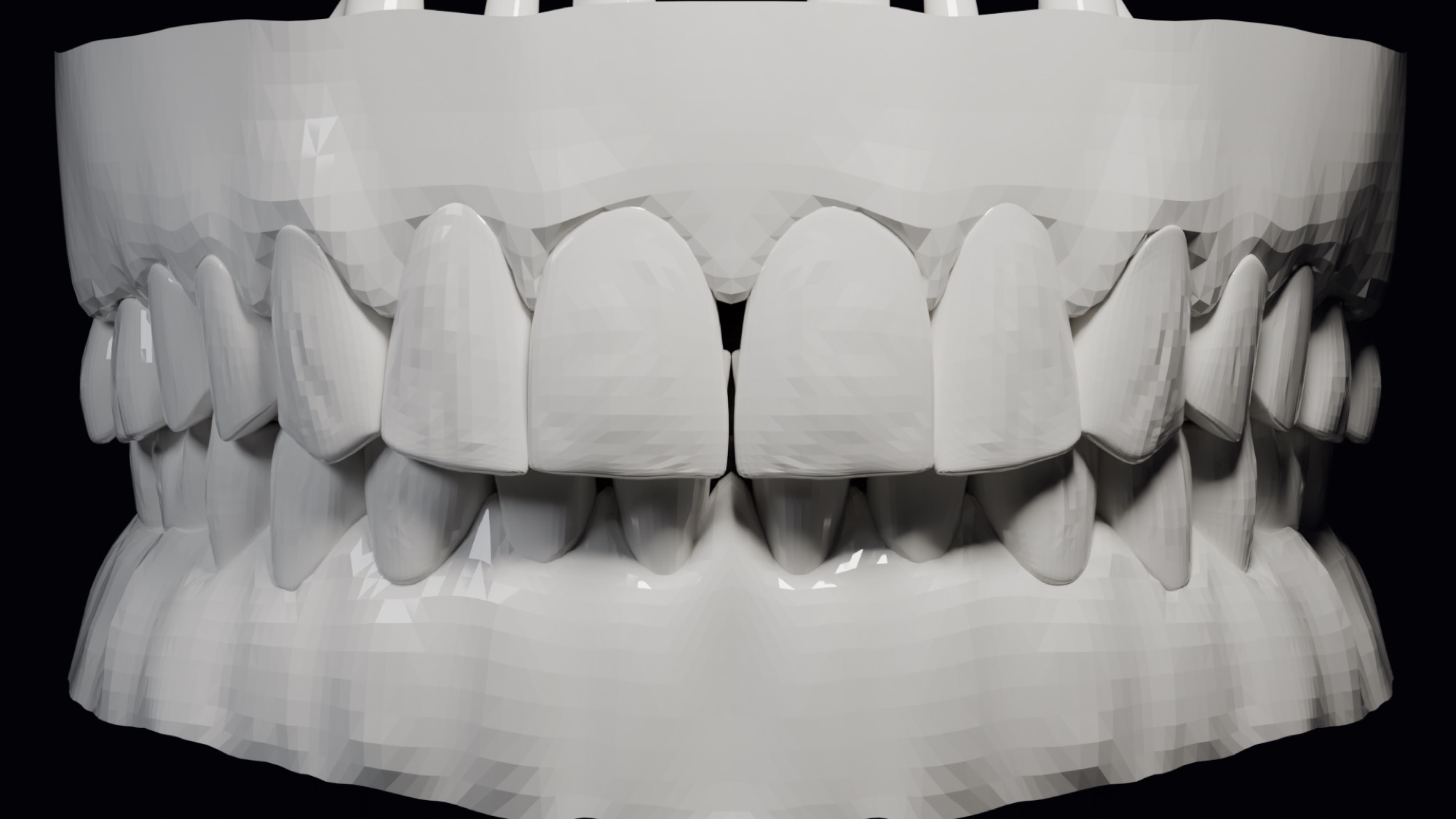 3D model of corrected teeth