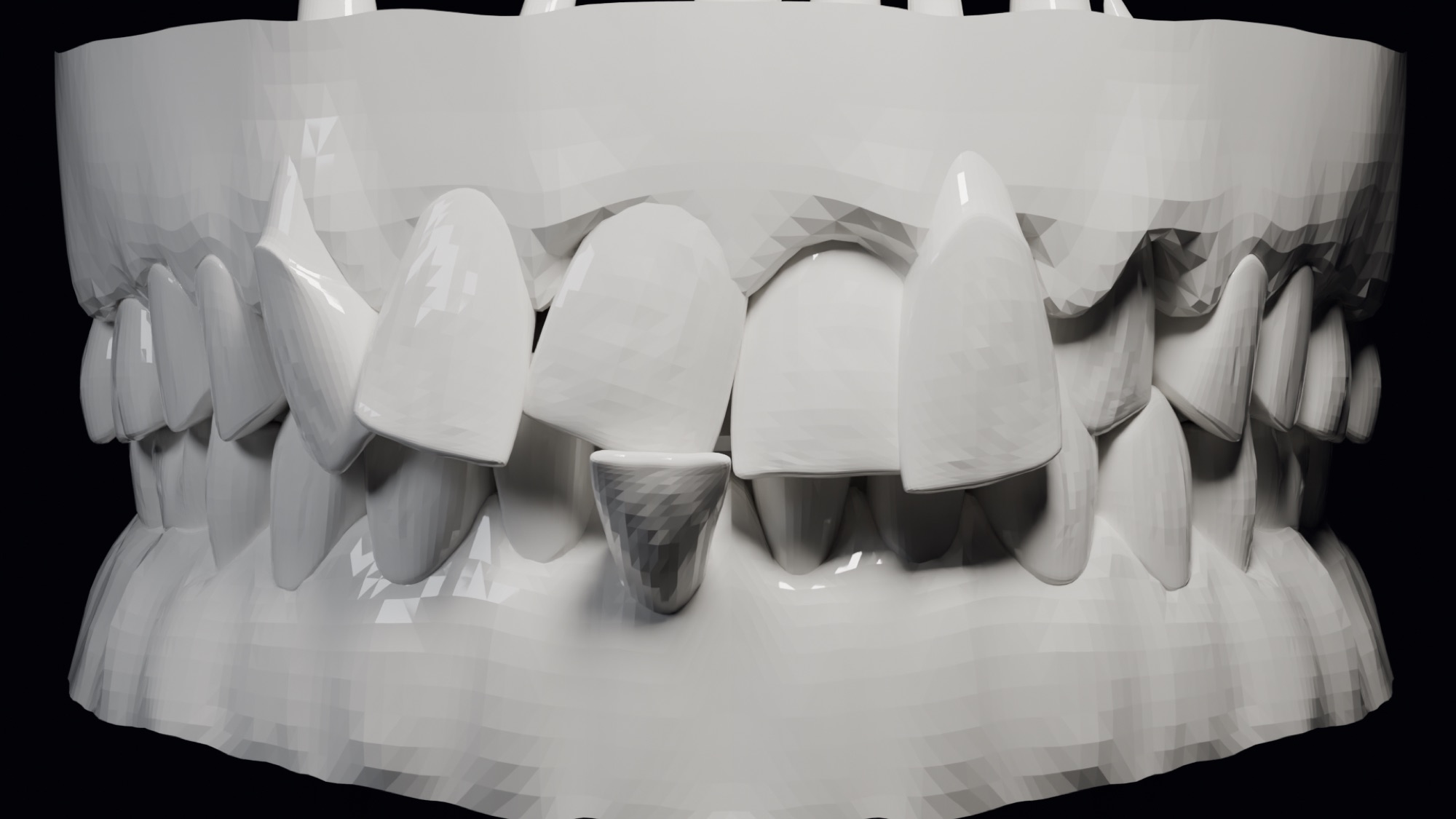 3D model of crooked teeth